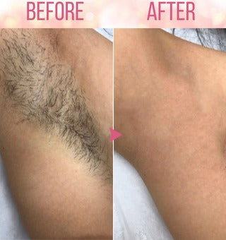 LuxeSilk™ - Ontharingsmousse