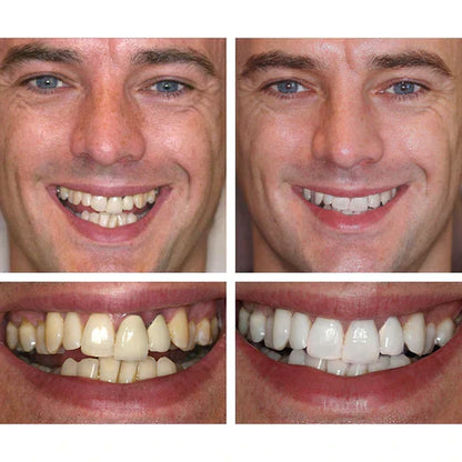 PureSmile™ Organic Teeth Whitening