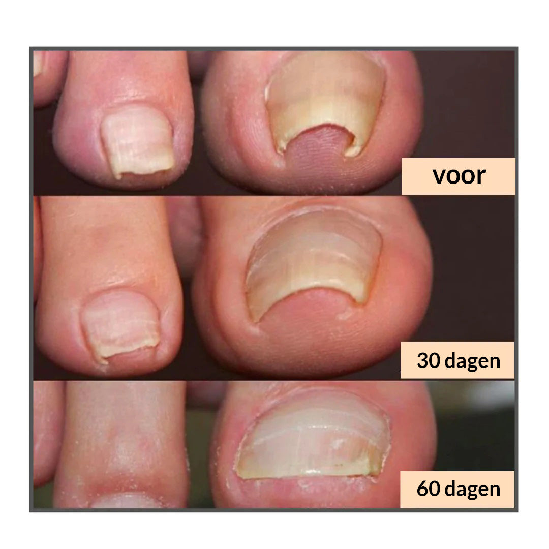 NailHealer™ | Corrigerende patch voor mooie en gezonde nagels
