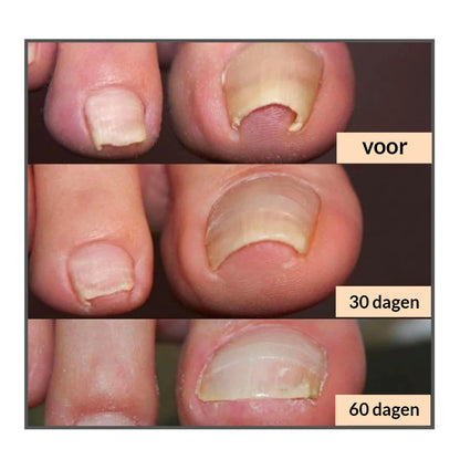 NailHealer™ | Corrigerende patch voor mooie en gezonde nagels
