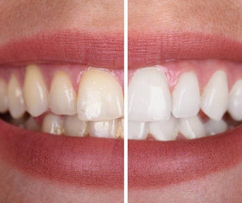 BeautySmile™  | geniet van een stralend witte lach zonder risico's! | 1+1 GRATIS